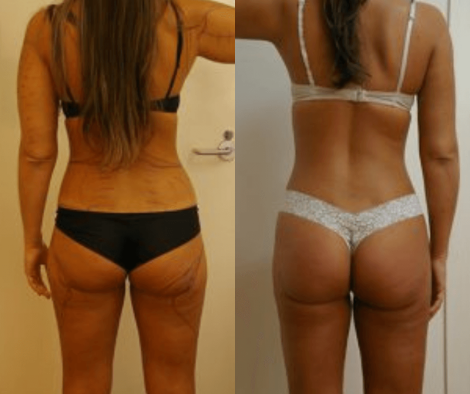 Banish Bra Bulge: How Back Liposuction Targets Unwanted Fat