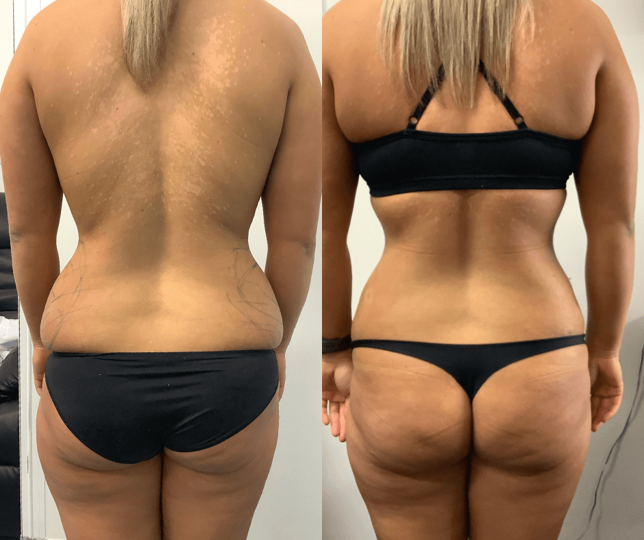 Breast Reduction Liposuction