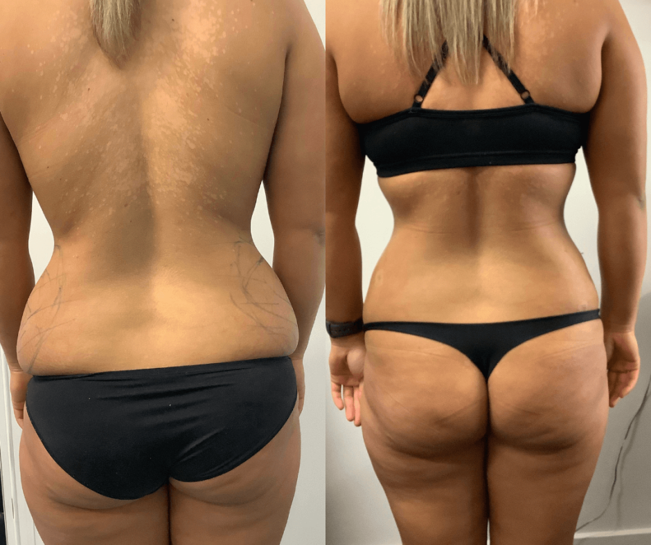 Tummy tuck with liposuction of the mons pubis, and a pubic lift
