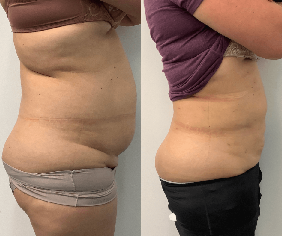 Abdominal and Stomach Liposuction
