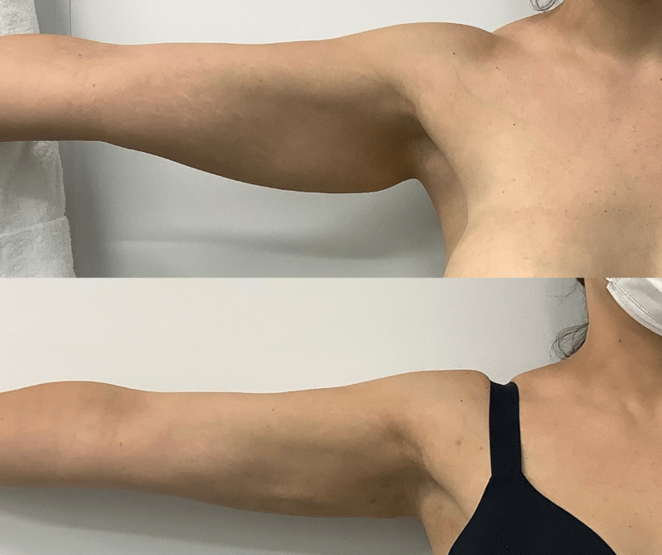 Armpit fat underarm wrinkled skin, Saggy skin removal. woman body