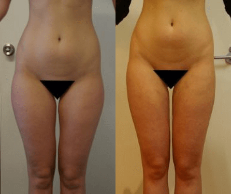 https://www.liposuctionaustralia.com.au/wp-content/uploads/elementor/thumbs/women-thighs-4-pe5fm4czqaf908rjdii27elzf8qt6tf7akq6eih5u0.png